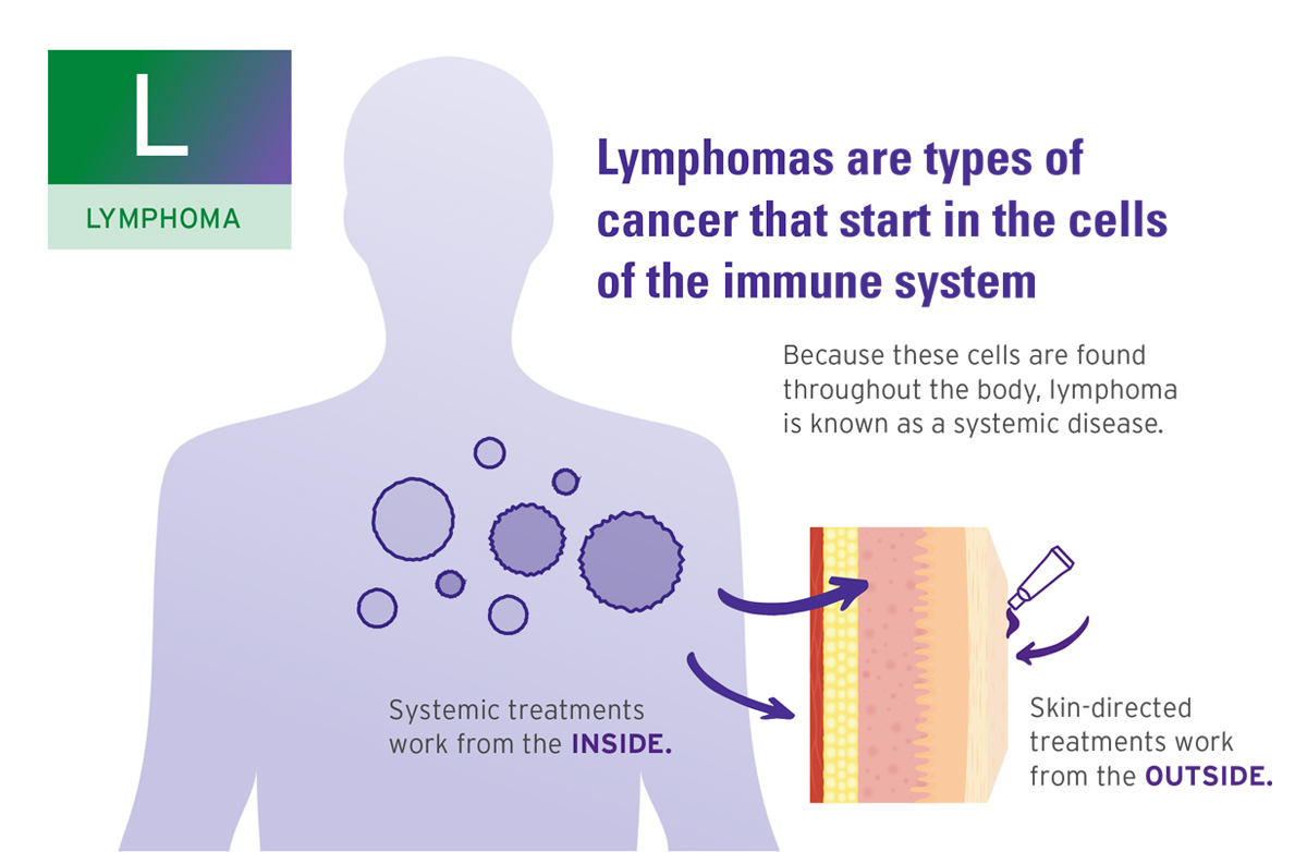 L Lymphoma Slide