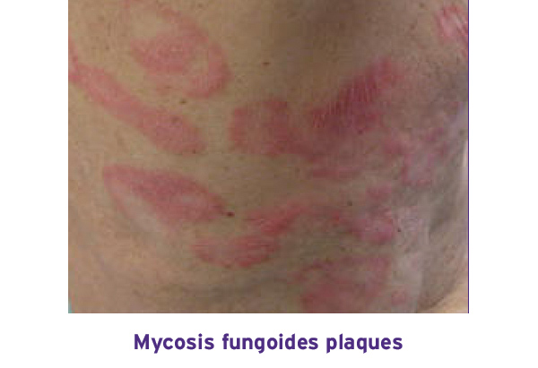 Mycosis Fungoides Plaques 3