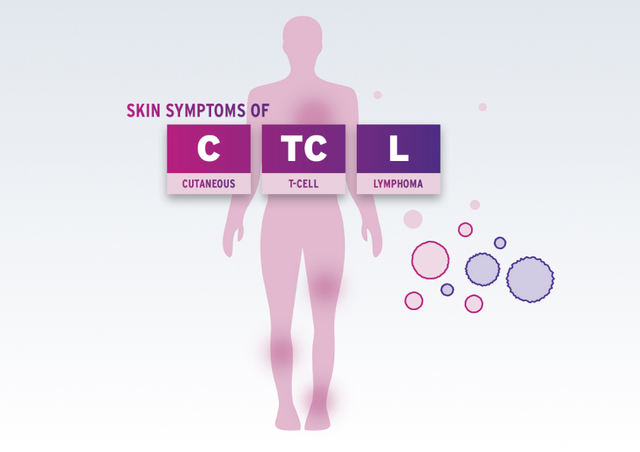 Image depicting symptoms of Cutaneous T-Cell Lymphoma (CTCL) on the skin.